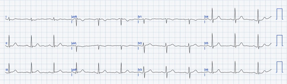 smithECGBlog's tweet photo. Chest pain in a 50-something. How important are serial ECGs in patients with persistent pain?

https://t.co/Brw1PiziZx https://t.co/y8k1ReYGOT
