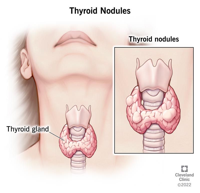 ClevelandClinic's tweet photo. A thyroid nodule is an unusual lump (growth) of cells on your thyroid gland.

Your thyroid gland is a small, butterfly-shaped endocrine gland located in your neck, below your Adam's apple. It produces the hormones thyroxine (also called T4) and triiodothyronine (also called T3). These hormones play a role in certain bodily functions, including:

Metabolism.
Body temperature.
Mood and excitability.
Pulse and heart rate.
Digestion.

Thyroid nodules are classified as:

Solitary (a single nodule).
Multiple (more than one nodule).
Cystic (fluid-filled).
Solid.

More than 90% of detected nodules in adults are noncancerous (benign), but they may represent thyroid cancer in approximately 4.0% to 6.5% of cases. Even though most thyroid nodules aren’t cancer, they can sometimes be a sign of and/or cause of thyroid disease. Anyone can have a thyroid nodule, including children and adults. However, they’re about four times more common in females than males. Healthcare providers detect them in approximately 5% to 7% of adults during a physical examination. Ultrasound imaging reveals that 20% to 76% of adults have thyroid nodules.

Most thyroid nodules don’t cause symptoms. However, if you have several nodules or large nodules, you may be able to see them.

In rare cases, nodules can grow big enough to cause symptoms like:

Trouble with swallowing or breathing.
Hoarseness or voice changes.
Pain in the front of your neck.
Enlargement of your thyroid gland (goiter).