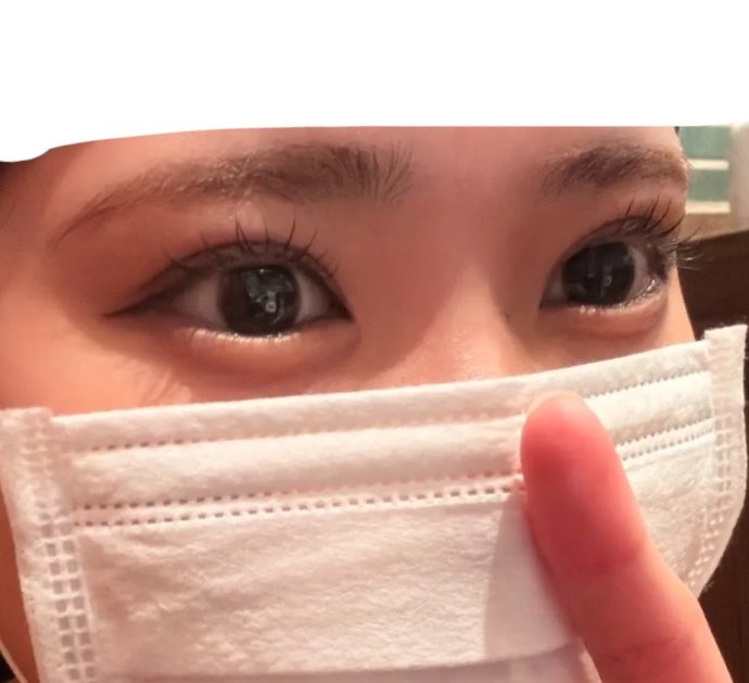 fu25n_'s tweet photo. 普段の写真だとこんな感じで、幅広すぎないけど目がくっきりして前より写真映えするようになった⭐️
涙袋のヒアルもちょうどいいかんじにみえる⭐️
 #二重全切開  #二重整形 https://t.co/neWjF2EQwV