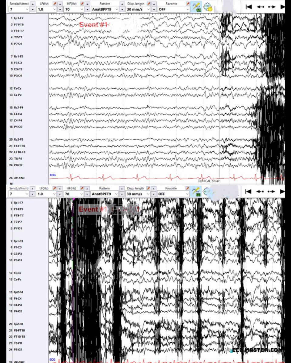 eeg_master's tweet photo. Based on electroclinical evolution in EEG, which is the most likely ILAE seizure classification? 

A. GTC
B. Focal sz with nonobservable manifestations 
C. Focal to b/l tonic-clonic sz
D. B/l tonic-clonic sz unknown whether focal or generalized 

Answer at https://t.co/PnsEbj4By2 https://t.co/cYf1xJXrWc