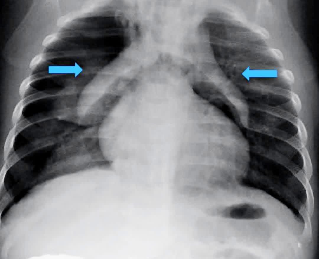 hemo_shk's tweet photo. #Patients with severe respiratory distress , desaturated ?

#What is the diagnosis and name the sign? https://t.co/ShNE11vZQ2