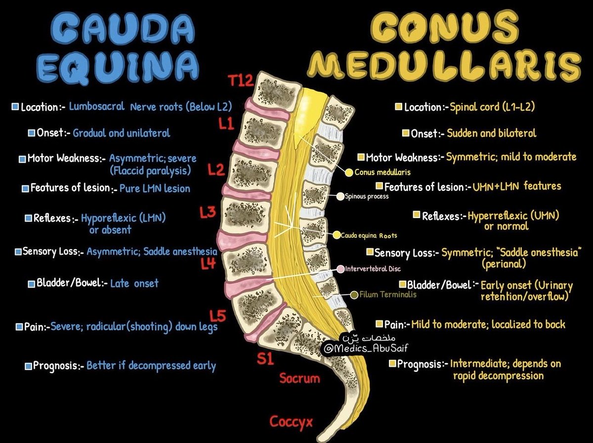 OGdukeneurosurg's tweet photo. Know the difference between cauda equina  syndrome and conus medullaris syndrome? @medics_AbuSaif https://t.co/zKnCxJ3HoL