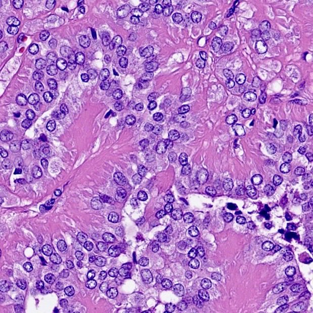 RDWhaleyMD's tweet photo. Now there are 3. 

Thyroid neoplasms harboring a novel OCLN::PRKCI gene fusion

https://t.co/N0ZmiTlV1n

https://t.co/p3uzbkgExG

#EndocrinePath #moldx #molpath https://t.co/OBV2oB3xxZ