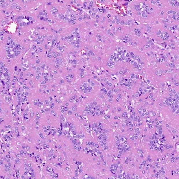 RDWhaleyMD's tweet photo. Now there are 3. 

Thyroid neoplasms harboring a novel OCLN::PRKCI gene fusion

https://t.co/N0ZmiTlV1n

https://t.co/p3uzbkgExG

#EndocrinePath #moldx #molpath https://t.co/OBV2oB3xxZ