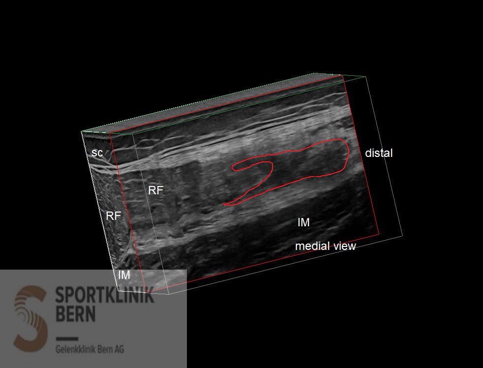 SportklinikBern's tweet photo. Myoofascial muscleinjury of the rectus femoris after 10 days - scan from proximal to distal - #mskus #pocus #pocushub #GElogiqE10sr4 https://t.co/LigoBHF27D