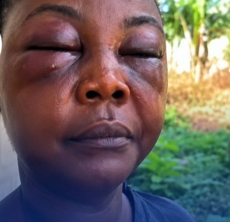 3Sixtytm's tweet photo. A woman in Agona Nyakrom in the Central Region has reportedly suffered severe eye injuries after she was allegedly assaulted by another woman over claims of an affair with a married man. Residents are calling on authorities to investigate the incident. https://t.co/FlKIVnH5V1
