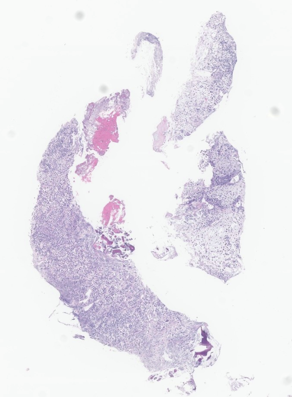 MinaXu7's tweet photo. 29 yo with "?osteomyelitis" what would you order after getting this small vertebral body lesion? Most helpful marker is shown in thread below. I must say that we weren't too optimistic about this being diagnostic at low power. https://t.co/wBxZd7wOKJ