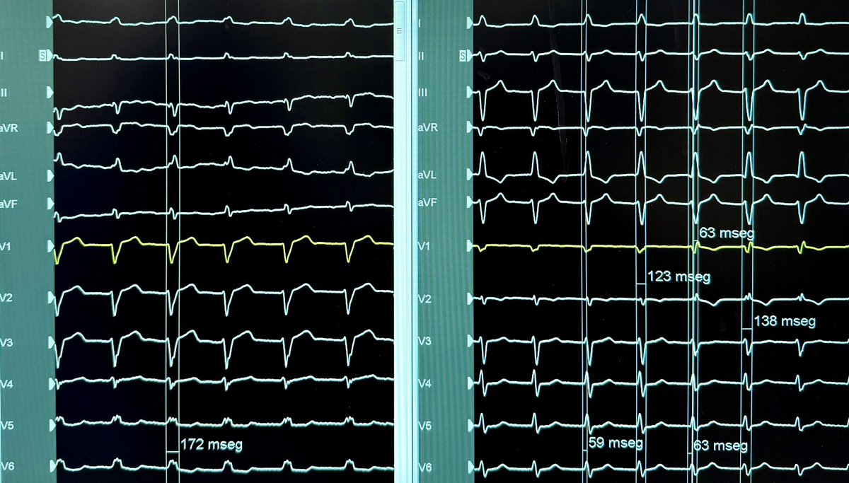 IsaParam's tweet photo. Syncope, first grade AV block and LBBB. Paroxysmal Complete AVB during monitoring. #CSP 
Done with @kellych11 
NS-LBBP and S-LBBP during the threshold test in bipolar mode https://t.co/h2r5Xes5pg