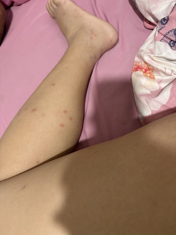Pollizstationn's tweet photo. É normal ter essas manchas com 18 anos ? 

@grok me explique… https://t.co/pKoR5Npbeo