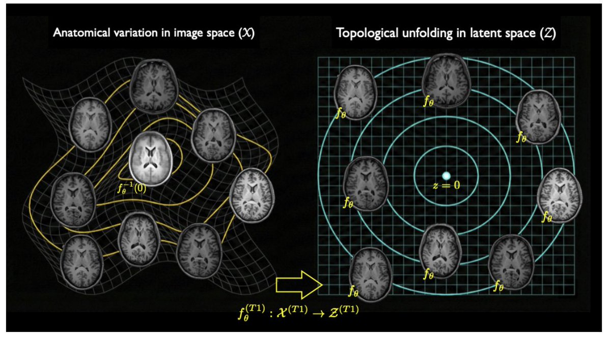 Tech_Bioinfo's tweet photo. **LAMNr flows achieve up to a +0.19 correlation uplift over linear baselines when predicting cognitive decline, while enabling closed-form cross-modal imputation in a single forward pass.** 🧠

The problem: Standard generative models (VAEs, GANs, diffusion) can't give you exact likelihoods *and* one-shot invertible latent spaces—critical for rigorous anatomical analysis.

The core innovation: The authors introduce Latent-Aligned Multiview Normalizing (LAMNr) flows, which learn shared + private latent subspaces across heterogeneous imaging modalities using alignment losses like VICReg, all while preserving exact log-likelihoods.

Key result: In the NNL cohort, LAMNr flows significantly outperformed linear SiMLR baselines—Working Memory saw a ∆r of +0.177 (q=0.024)—and enabled zero-shot T1→FA imputation via closed-form Gaussian conditioning.

This framework essentially redefines computational anatomy: population templates become the latent origin, geodesics become spherical interpolation, and missing modalities become conditional expectations.

Could this make traditional diffeomorphic registration pipelines obsolete for multimodal analysis? 🔥

#MachineLearning #DeepLearning #MedicalImaging #NormalizingFlows #ComputationalAnatomy #Neuroimaging #AI

📄 Paper: https://t.co/Zq5ySIFvb7