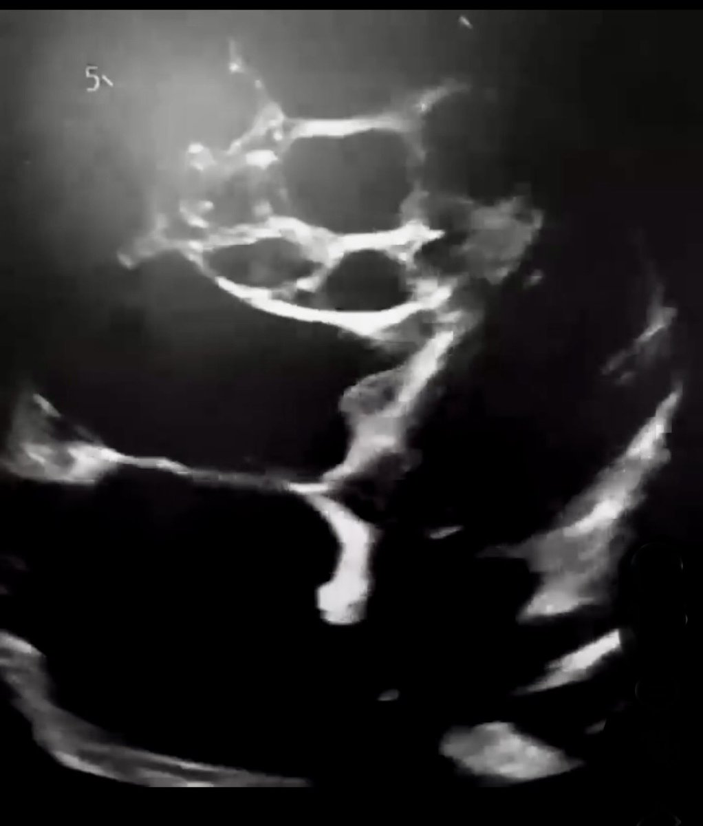echogenics's tweet photo. #echogenics #echofirst #ASE This striking echocardiogram presents a fascinating view of hydatid cysts situated in the right ventricle. The intricate patterns and contours captured reveal the complexity of this cardiac condition, as the cysts appear as distinct, shadowy formations against the heart's muscular walls. The image highlights the importance of advanced imaging techniques in diagnosing and managing such conditions, showcasing the heart's anatomy with both clarity and artistry.
Such insights are essential for healthcare professionals, emphasizing the critical interplay between technology and patient care. Sharing this image not only illustrates the marvels of medical imaging but also sparks important conversations about rare cardiac ailments and their implications on overall health.