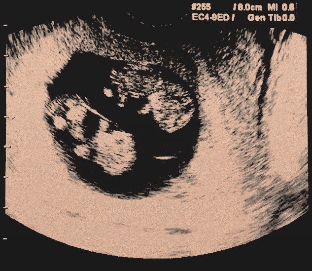 empathysgt's tweet photo. ᅠ
added two more to our little nest.

all of us are so happy you’re here. still trying to find words for the joy it fills me with. you two gave us a scare, but it’s worth it with you both here.

your dad and I love you two so so much already. 
ᅠ https://t.co/mWWDCT9tg3