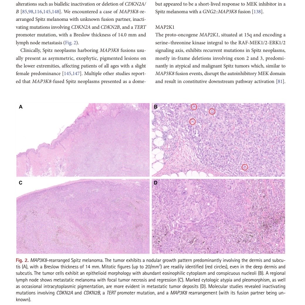 DrAldehyde's tweet photo. ๐จ Hot off the press! Our most comprehensive review of old and new gene fusions in melanocytic neoplasms is now available online. ๐๐ฌ๐งฌ
Check it out if you love the #dermpath and #molepath combo. The article is open access.
https://t.co/xiKgWfcUED https://t.co/imtRnkGiVx