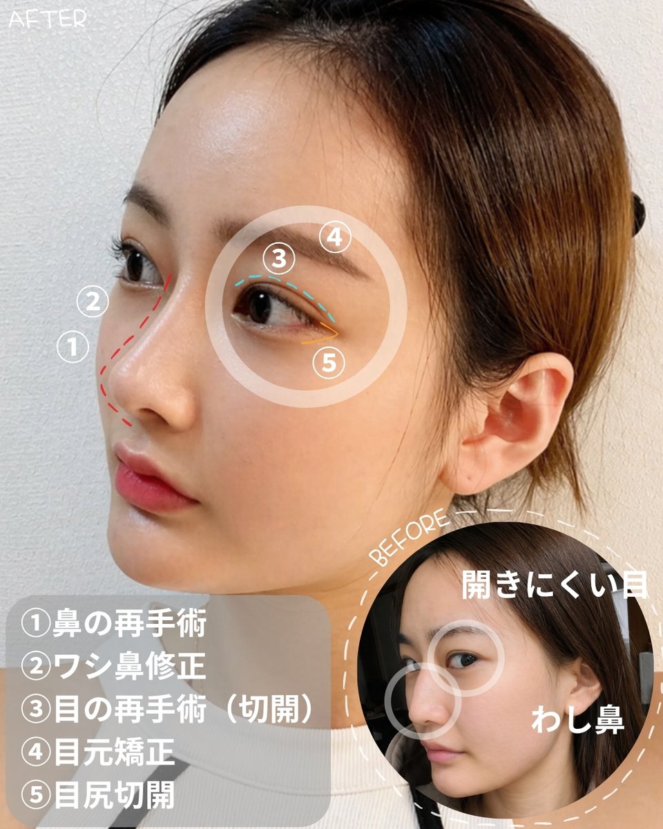 トップフェイス整形外科/目再手術・鼻再手術 tweet media