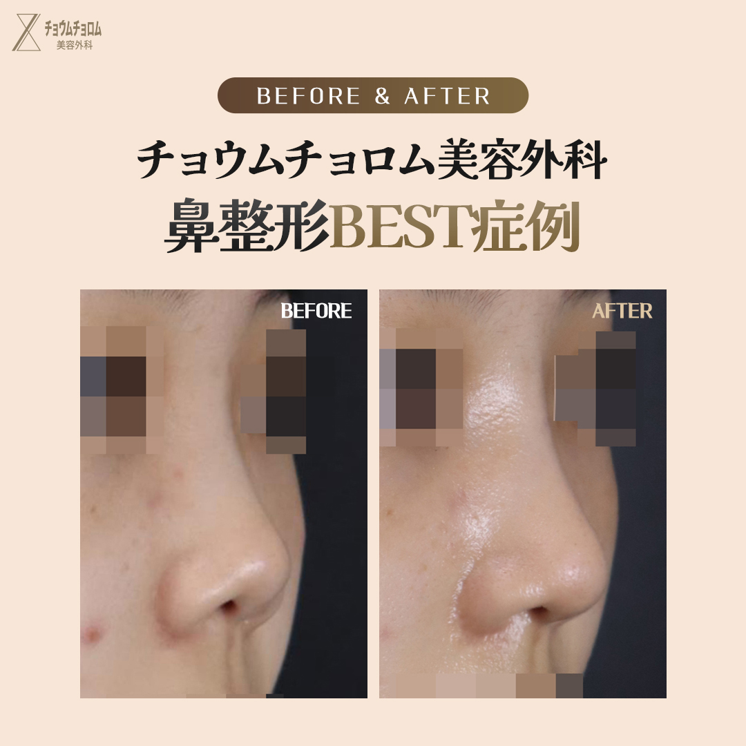 likefirst_jp's tweet photo. チョウムチョロムが教える
#整形手術 Before&After

目、鼻手術はすべて自信あります。
チョウムチョロム美容外科では’工場式’のような画一的な手術は行いません。
患者の目、鼻の形と年齢、シーズンなどの状態に合わせて
1：1パーソナライズで安全に手術を行う事をお約束します。
カウンセリングから手術、後管理まで代表院長1：1責任制で全ての過程を担当し、
嘘のない診療を行います。

#チョウムチョロム美容整形外科　#目整形　#鼻整形
#代表院長パーソナライズカウンセリング無料
#江南駅

#チョウムチョロム美容整形外科 #鼻整形 #小鼻縮小 #ナチュラル #鼻整形 #鼻再手術 #拘縮鼻 #韓国整形 #鼻中隔延長 #鼻鏧形レポ #鼻先 #鼻形 #美容整形 #形 #軟骨移植 #鼻整形レビュー #プチ軽形 #中年整形 #美意識 #美容オタク #美容整形外科 #形メイク #鼻尖形成 #軟骨移植 #鼻整形レポ #整形レポ #美容整形 #美容外科 #美容整形外科 #韓国ビューティー
