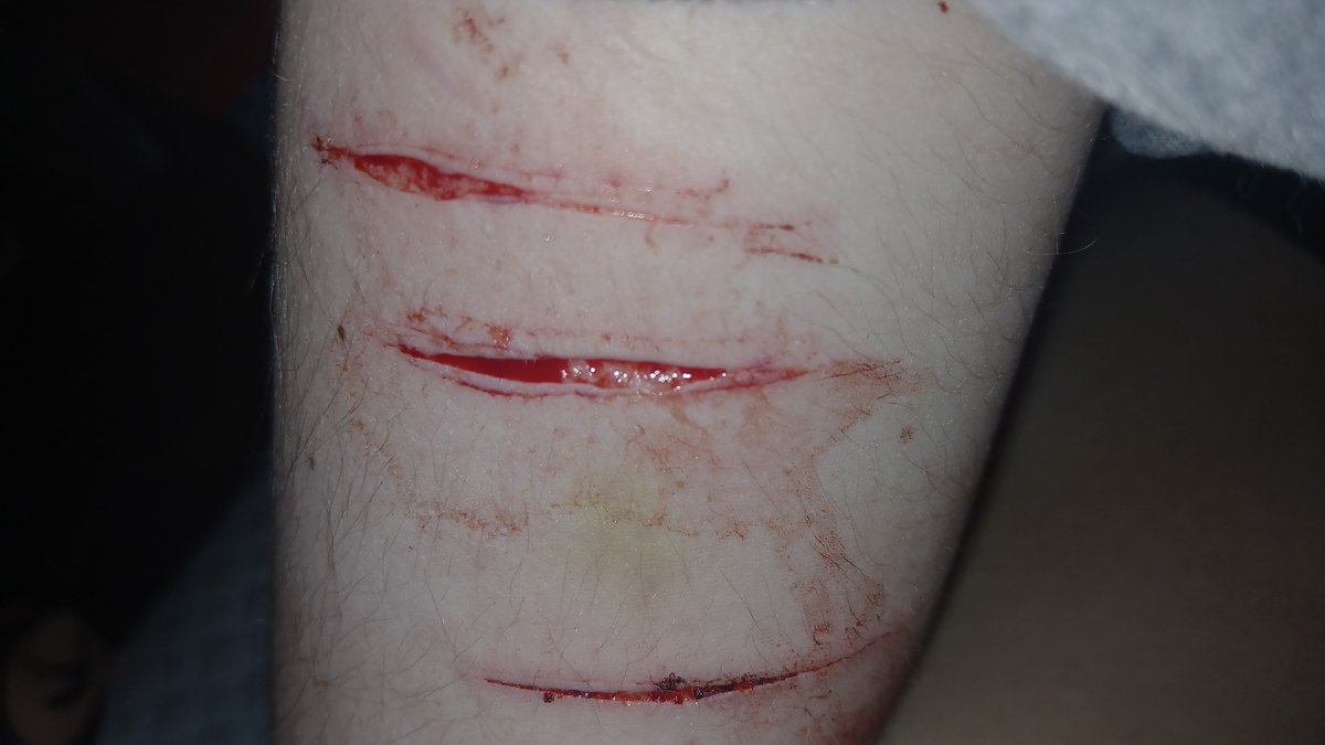 2PPoland's tweet photo. Baby beans on bicep I made by taping this tiny blade to a stick
I wanna go deeper but my mom's breathing down my neck #slittwt 
#slittertwt #shedtwt https://t.co/EafgI7eMAk