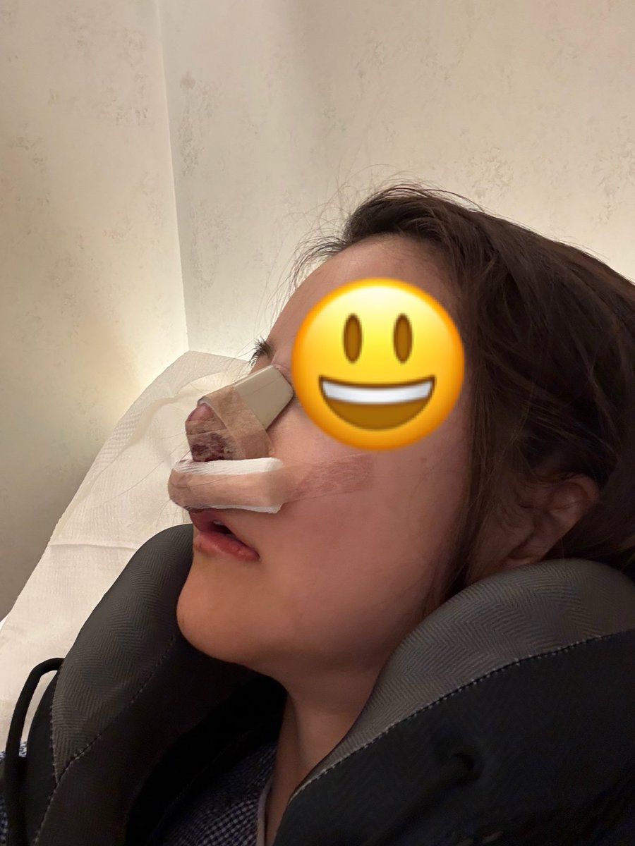 89chan_'s tweet photo. ルーブル鼻フル4回目
術後当日

鼻先しっかり高さ出たのでは🎶仕上がり楽しみ🎶
#ルーヴル美容外科 https://t.co/FBWN7E7Mir