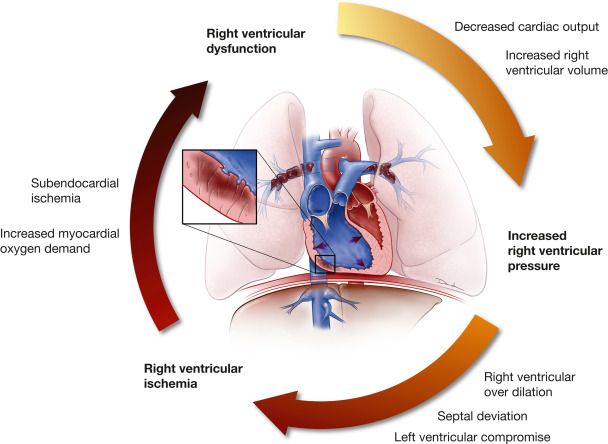CritCareReviews's tweet photo. Today's Paper of the Day is:

Management Strategies for Acute Pulmonary Embolism in the ICU

https://t.co/JKgcYjlUQ5

Join us to read 1 paper per day and stay up-to-date as we cover the spectrum of critical care across 2026 https://t.co/79ESg21bQy