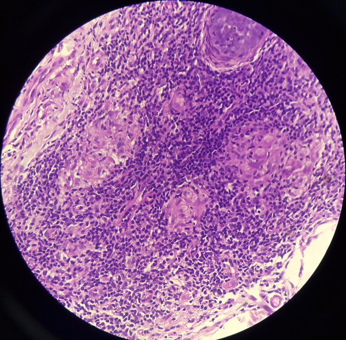 arthy_os's tweet photo. 42/m, 5x5cm circular patch with mild reduction in sensation in left elbow. skin shows multiple well formed epithelioid granulomas. TUBERCULOID LEPROSY. https://t.co/TMAp1ryNFg