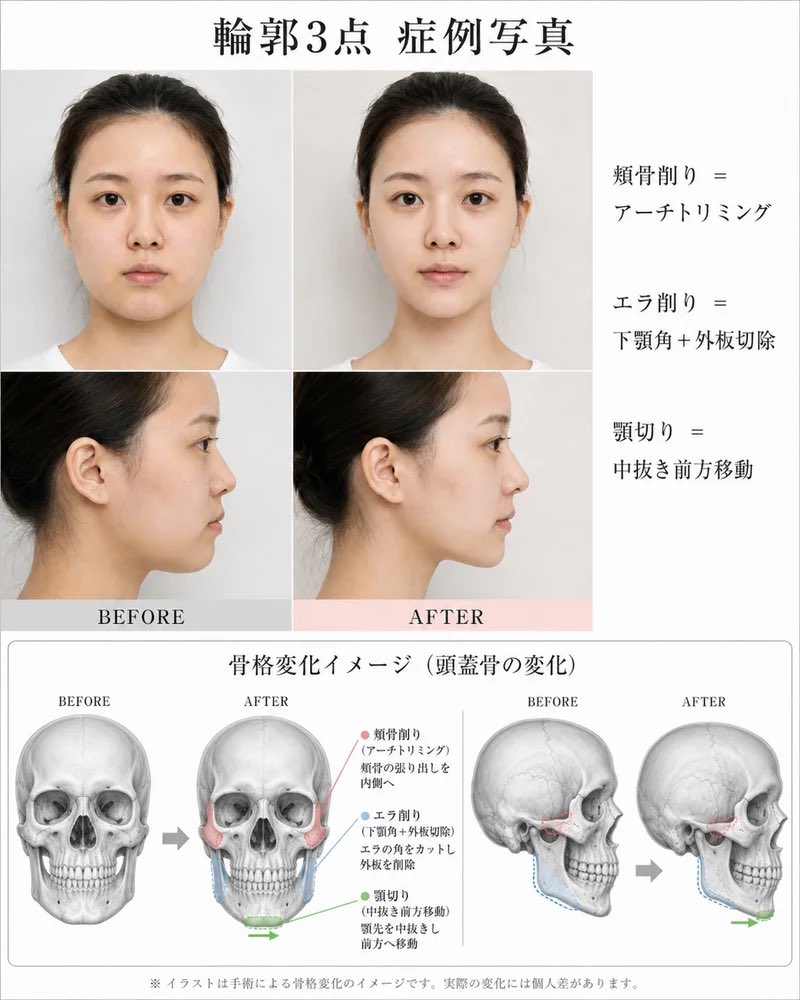 輪郭3点良医選び🏥エラ削り、頬骨削り、両顎手術、顔脂肪吸引、鼻中隔延長、鼻尖形成、小鼻縮小、鼻整形 tweet media