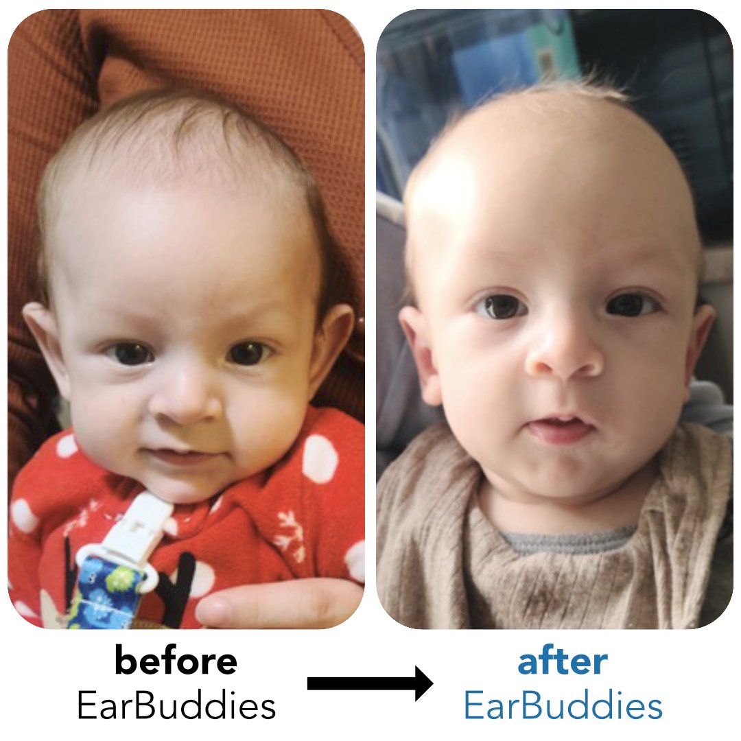 EarBuddies's tweet photo. This California Dad 🇺🇸 permanently corrected his son's Stick-Out Ears with @EarBuddies

"I did not want my son to experience all the bullying and teasing I experienced as a child. Thank you for changing our baby's life!"

Read his story here: https://t.co/yYjnRRFKL3

#EarBuddies https://t.co/x6adPQtikp