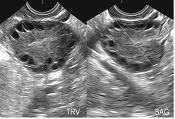 Radblogtv70's tweet photo. Dear Rads,
Be informed about the name changed from PCOS to PMOS.

However, do not suddenly replace PCOM with PMOS in reports simply because of ongoing naming debates.

The safest and most academically accurate reporting terminology remains:
“Polycystic ovarian morphology (PCOM)” https://t.co/PDkWcBpH4H