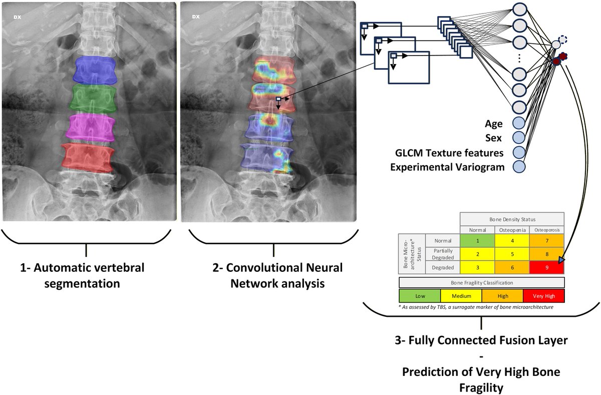 eClinicalMed's tweet photo. Validation of a deep learning model for bone fragility detection from conventional radiographs: an international cohort study
The proposed approach provides rapid identification of individuals with very high #BoneFragility from routine radiographs
https://t.co/0aBwT4goFI https://t.co/UrqN7ZoJzb