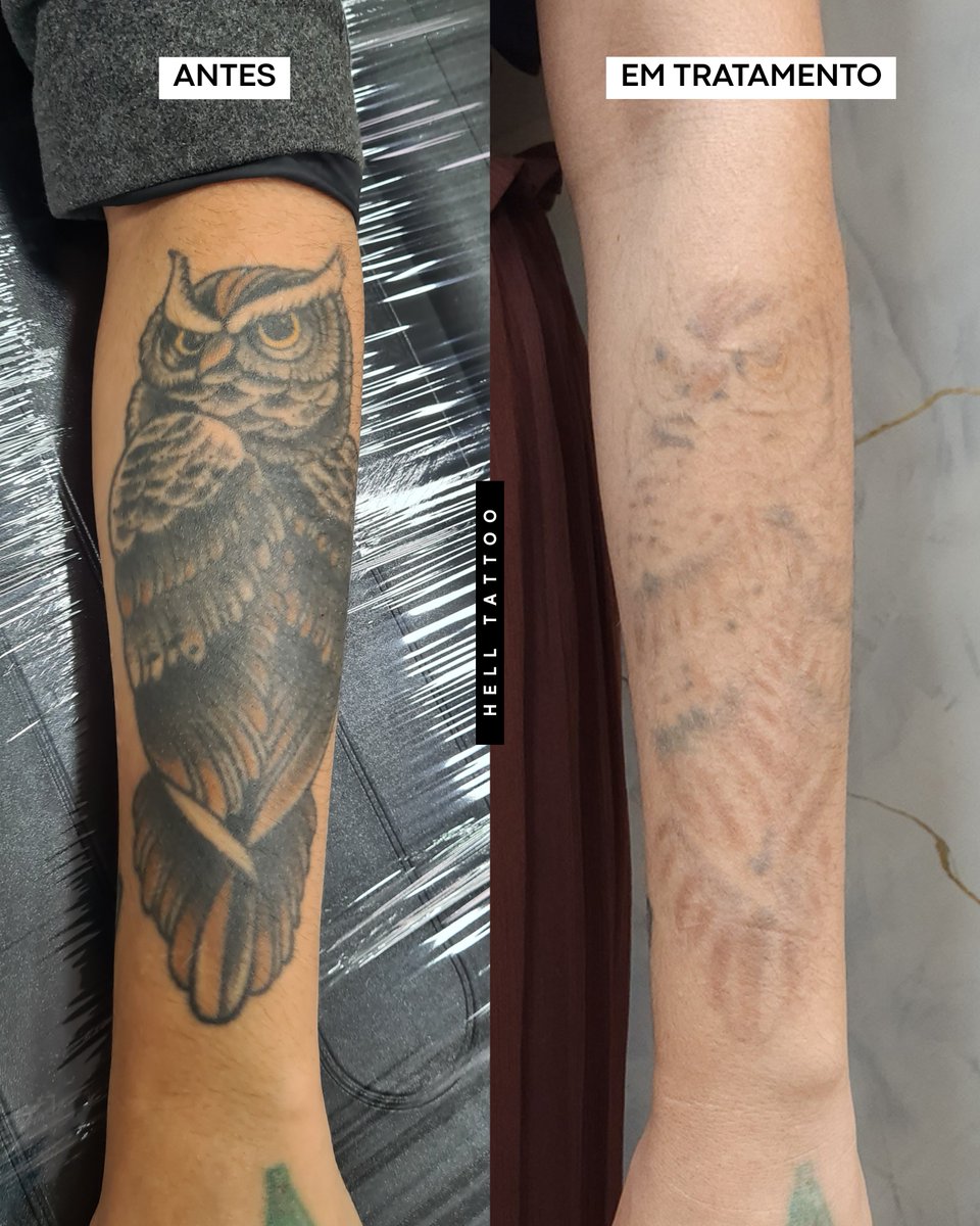 helltatto's tweet photo. 🦉Remoção de tatuagem exige técnica, tecnologia e paciência. Mesmo em uma coruja escura e muito saturada no antebraço, o clareamento já é visível: contornos mais suaves, sombras abrindo e pele preservada.
Cada sessão faz parte de um processo estratégico para resultados. 👊🏼 https://t.co/3k37pWYzbA