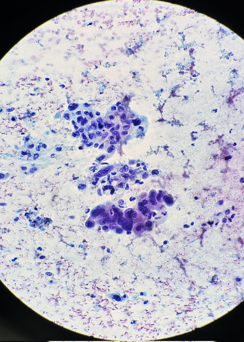 DrRanasaleh's tweet photo. Elderly male patient with pancreatic head mass, EUS FNA done
@kriyer68
#cytology #EUS #gipath #cytopath https://t.co/6LiwZ9eyeU