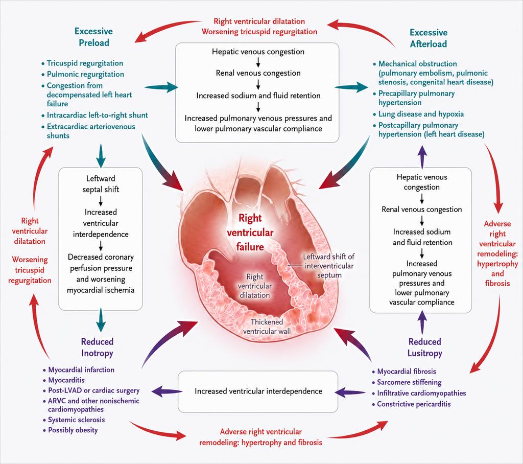 TrackYourHeart's tweet photo. Pathophysiology of Right Ventricular Failure https://t.co/RqMy90rTqD