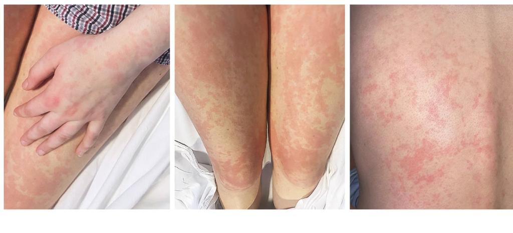 A 27-year-old woman has had fever for 2 weeks, along with joint pain ...