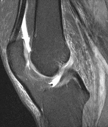 AB_drmd's tweet photo. 🚨🚨🚨شاب انتفخت ركبته فجأه بعد ما لعب كرة قدم ⚽️، قررت تسوي له MRI ...

⁉️ايش التشخيص؟؟؟ https://t.co/6kPq5oJp8j