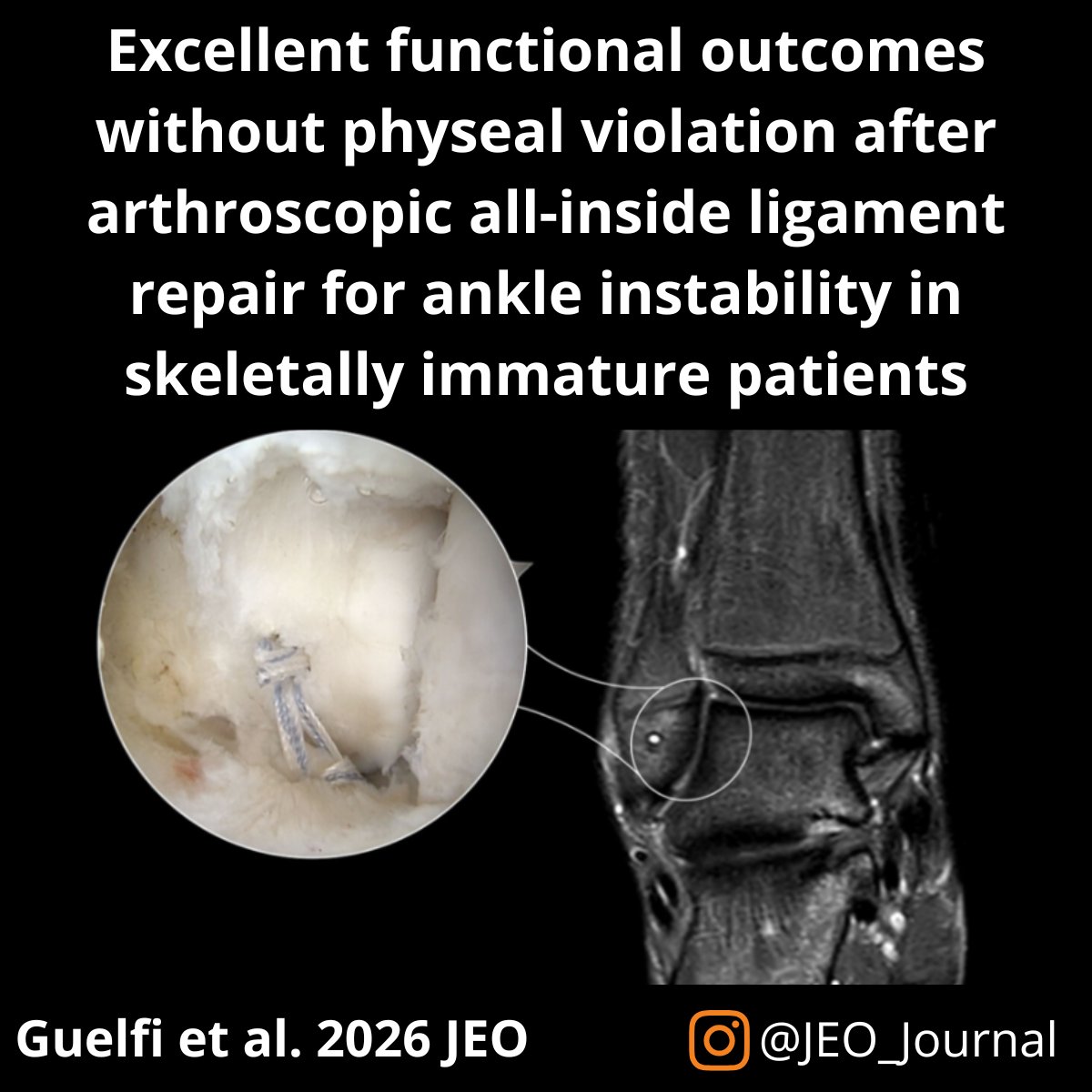 JEO_journal's tweet photo. This study showed that ankle instability in skeletally immature patients can be successfully treated with arthroscopic all-inside ligament repair. 

OPEN ACCESS article: https://t.co/zFybif5Vua

#ankle #ATFL #ligament https://t.co/ahwupRJ3VH