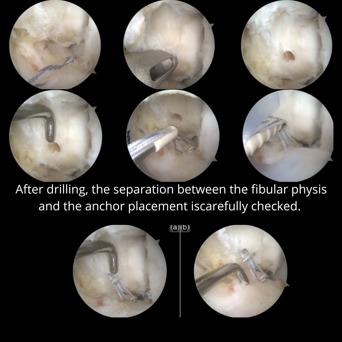 JEO_journal's tweet photo. This study showed that ankle instability in skeletally immature patients can be successfully treated with arthroscopic all-inside ligament repair. 

OPEN ACCESS article: https://t.co/zFybif5Vua

#ankle #ATFL #ligament https://t.co/ahwupRJ3VH