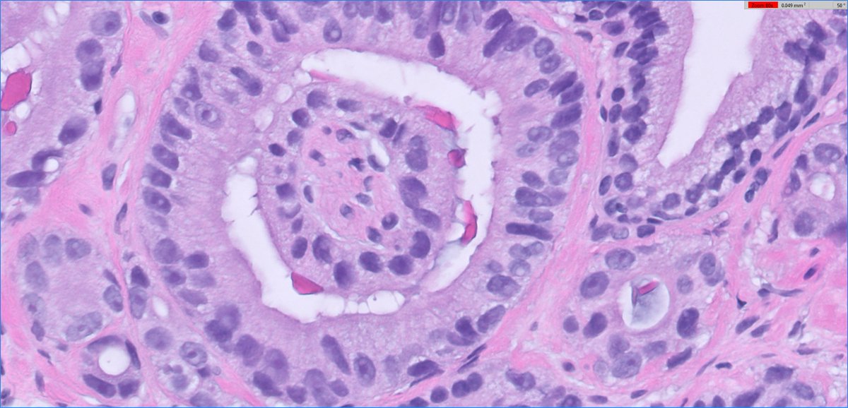 slusagar's tweet photo. #GUpath prostate bx:
telescoping PNI - mimic of glomerulation (not pattern 4) https://t.co/rseE2uiV1K