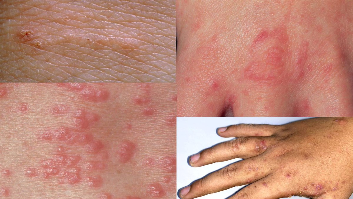 dokitawaa's tweet photo. Not every genital itch is an STI.

Sometimes tiny mites literally burrow under the skin causing intense “crawl crawl” itching that gets worse at night.

It’s called scabies and it can spread through close skin contact, partners, bedding, and even entire households.

Most people don’t realize they have it until the itching becomes unbearable.