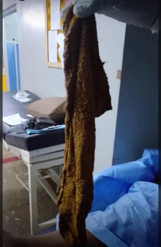 northern_trends's tweet photo. 🚨🚨 SHOCKING AND HEARTBREAKING STORY 😭💔

A tragic incident has reportedly claimed the life of the SUG Vice President of Aliko Dangote University after doctors allegedly forgot a surgical towel inside her body during an operation.

According to reports, she suffered severe pain and complications for months without knowing the real cause, before sadly passing away today. 😭

This shocking case has sparked outrage, as many are calling it a clear case of medical negligence and carelessness.

How can a young life be lost in such a painful and avoidable way? Hospitals are meant to save lives, not destroy them through reckless mistakes.

The public is now demanding an immediate investigation into the hospital, the doctors involved, and everyone connected to the surgery. Those responsible must be held accountable according to the law.

Please share this story across all social media platforms until justice is served. Another innocent life must not be lost because of negligence. 💔