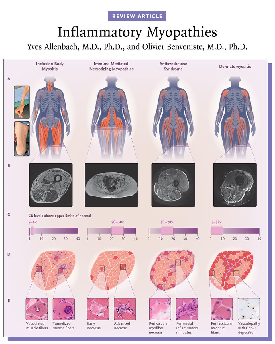 AlexStibi's tweet photo. An amazing review on one of my favourite topics in #systemic diseases: inflammatory #myopathies!!
@NEJM 

⬇️⬇️
🔗https://t.co/thvLEzNZ8c https://t.co/XRHmf580QD