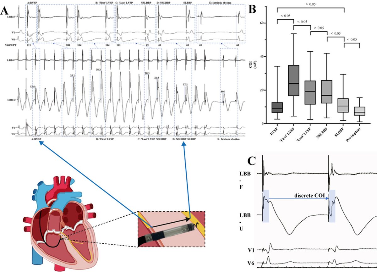 hrs_journal's tweet photo. Electrophysiological characteristics of lead-position-dependent electrogram uninterrupted transition during left bundle branch pacing #OpenAccess 

@JiaboS89929 

https://t.co/QnqnEuwhnb https://t.co/LcWWhEQ2R6