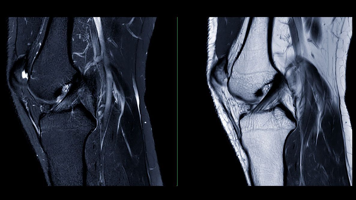vailknee's tweet photo. Not every ACL tear requires surgery.

In his latest blog, Dr. Cunningham explains when patients with a partial ACL tear may recover successfully with physical therapy and when ACL reconstruction may still be needed.

Learn more: https://t.co/Cl7LEA7lZG 

#ACL #SportsMedicine https://t.co/Wlv9V6P6M5