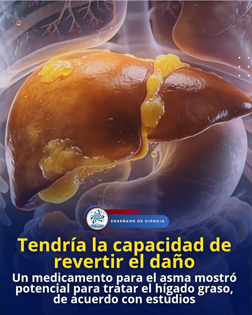 EnsedeCiencia's tweet photo. 🚨 Científicos de la Medical University of South Carolina encontraron un posible nuevo uso de un fármaco para tratar el asma. Y es que también tendría la capacidad de revertir el daño ocasionado por la esteatohepatitis asociada a disfunción metabólica (MASH). Esta enfermedad está vinculada con obesidad y diabetes.