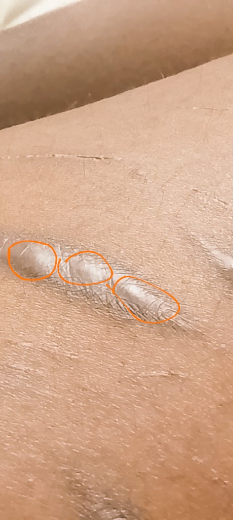MaturanaSa24596's tweet photo. Ola, alguien sabe porque mi cicatriz trae tres protuberancias? Anexo fotos

Help

#cutwt #sh #selfharmtwt #scarpotwt #scarpo #shedtwt #scartwt https://t.co/oHupOOin7C