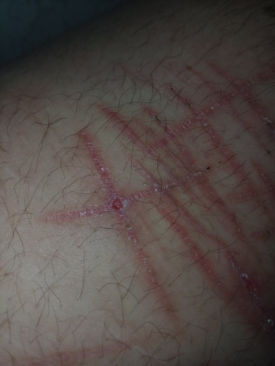 atsushistiger's tweet photo. I LOVE picking scabs literally cant help it but i HATE when they leave these gross holes (¬_¬") https://t.co/6054eKPQt9