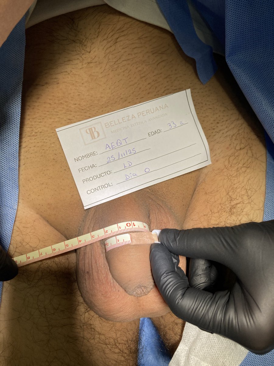 Dra__Fit's tweet photo. Hola mis Pepitos, les traigo otro caso, este llegó con una medida de 10.3cm  y después de 1 mes la medida aumentó 3.2cm a 13.5cm de circunferencia.

Si tú también quieres tener estos resultados, escríbeme para agendar tu cita🍆🔥

#engrosamiento #limaperu https://t.co/htZRNGAIJO