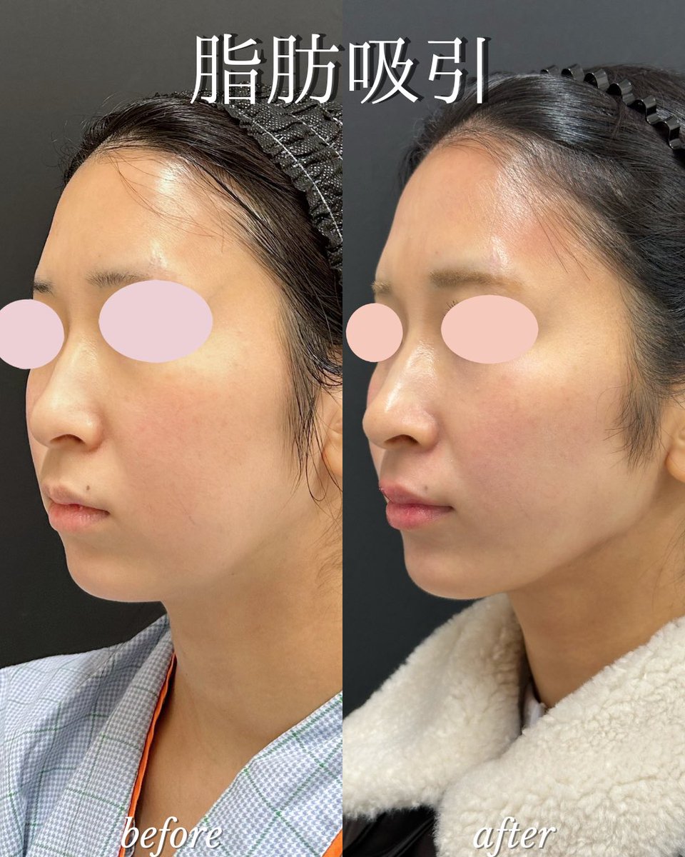 lbc_drnoto's tweet photo. ルラ美容クリニック札幌大通院　能登貴弘
【施術名】脂肪吸引
【リスク】腫れ、内出血、ボコつき
【価格】11万円〜
ご予約は下記
https://t.co/QAclSHpcmB
#ルラ美容クリニック札幌大通院
#ルラ美容クリニック https://t.co/HZfrnbq9j7