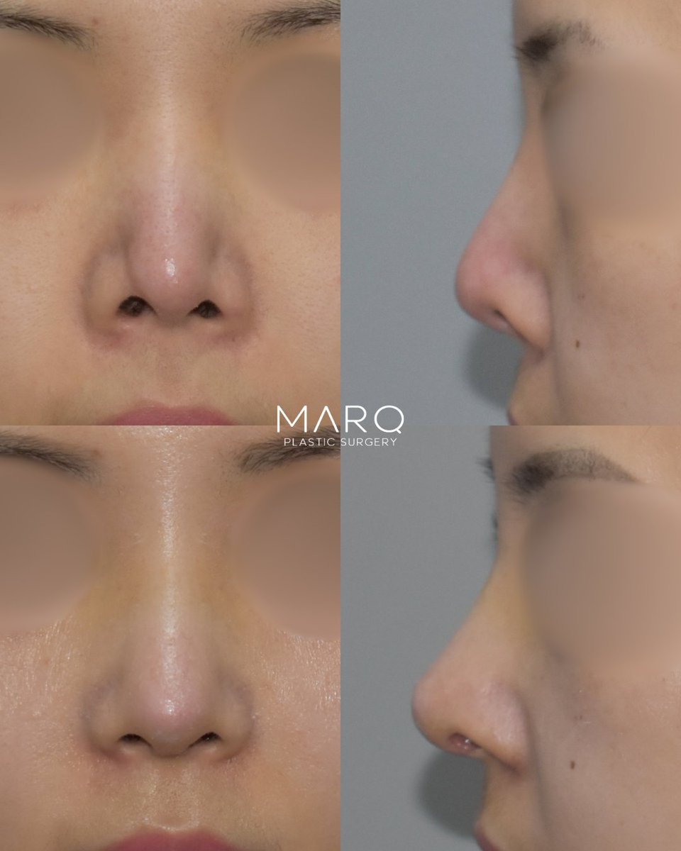 MARQ_PS's tweet photo. ╭━━━━━━━━╮
　#MARQ症例写真
╰━━━ｖ━━━━╯

以前の手術の副作用で起きてしまった
ピンチノーズと鼻の穴の露出を改善して
なめらかなラインの四角形鼻に✨

【執刀医】
👨🏻‍⚕️イ・ジェジュン代表院長

【手術内容】
✔プロテーゼ+鼻再手術

📍3号線新沙駅1番出口徒歩4分
📩LINE https://t.co/3iYD1qnVKx

#鼻フル #鼻整形 #韓国整形 #鼻尖形成 #渡韓整形 #ACR