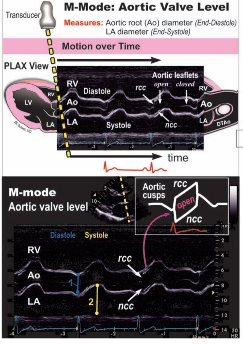 TrackYourHeart's tweet photo. M-Mode Echocardiography at Aortic Valve Level (PLAX View)

This M-mode image captures the motion of the heart over time at the aortic valve level, offering high temporal resolution.

✅ Cursor Alignment
The M-mode cursor (dashed yellow line) is placed perpendicular to the aortic root, passing through the aortic valve cusps (RCC & NCC), the aortic root (Ao), left atrium (LA), and right ventricle (RV). Precise alignment is key for accurate measurement.

✅ Normal Aortic Cusp Motion
- During systole, the RCC and NCC move apart, creating a box-like opening, a hallmark of normal aortic valve excursion.
- During diastole, the cusps coapt centrally, forming a thin linear closure line.

✅ Measurements
1️⃣ Aortic Root Diameter (blue): Measured at end-diastole, when the aortic valve is closed.
2️⃣ Left Atrial Diameter (yellow): Measured at end-systole, when LA size is maximal.

M-mode at the aortic valve level is a fundamental tool for evaluating valve motion, root dilation, and LA enlargement.

Ref: Figure 6.12, Basic Echo  PLAX M-mode Assessment