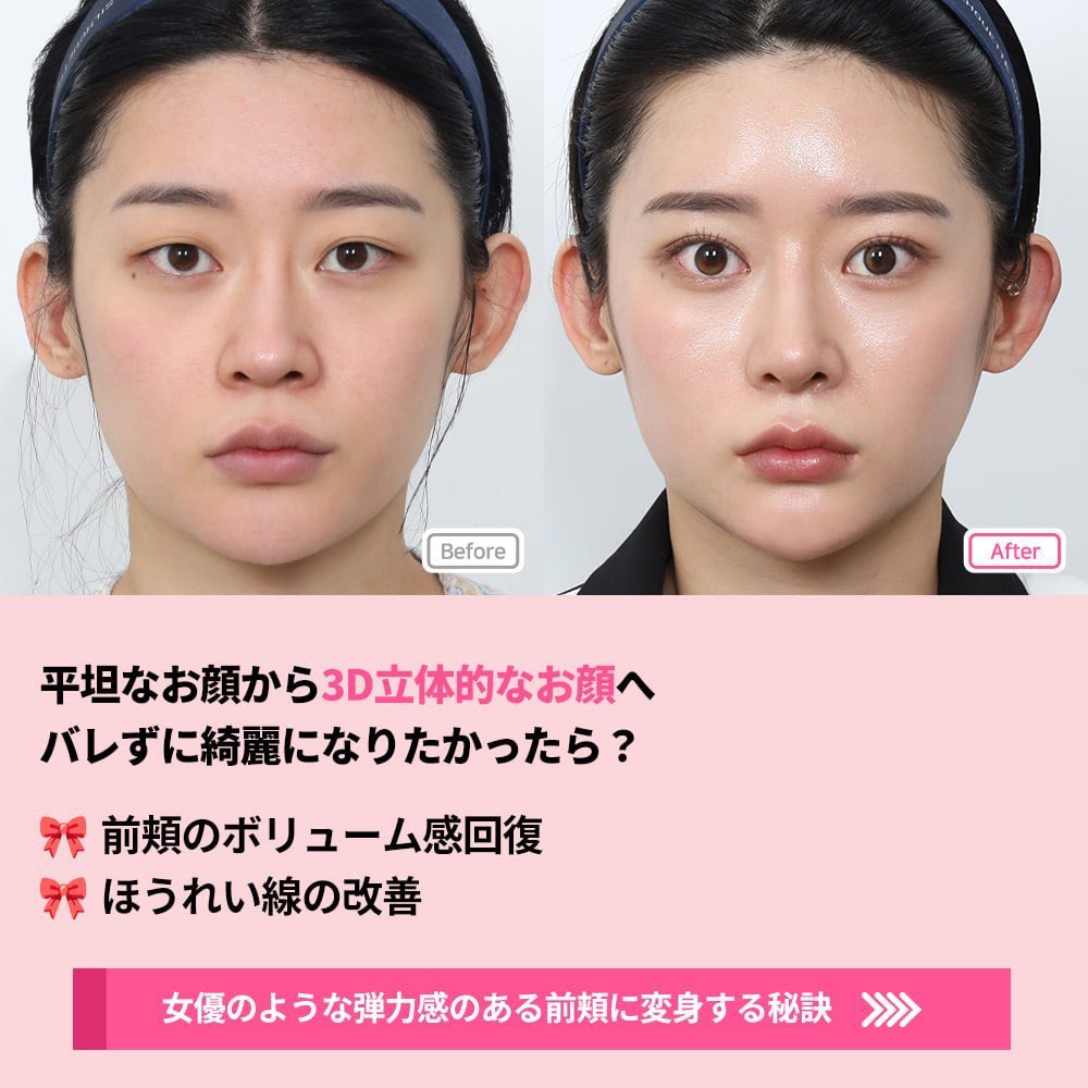 【韓国】糸リフト・目の下脂肪再配置・目整形専門ジャスト美容整形外科 tweet media