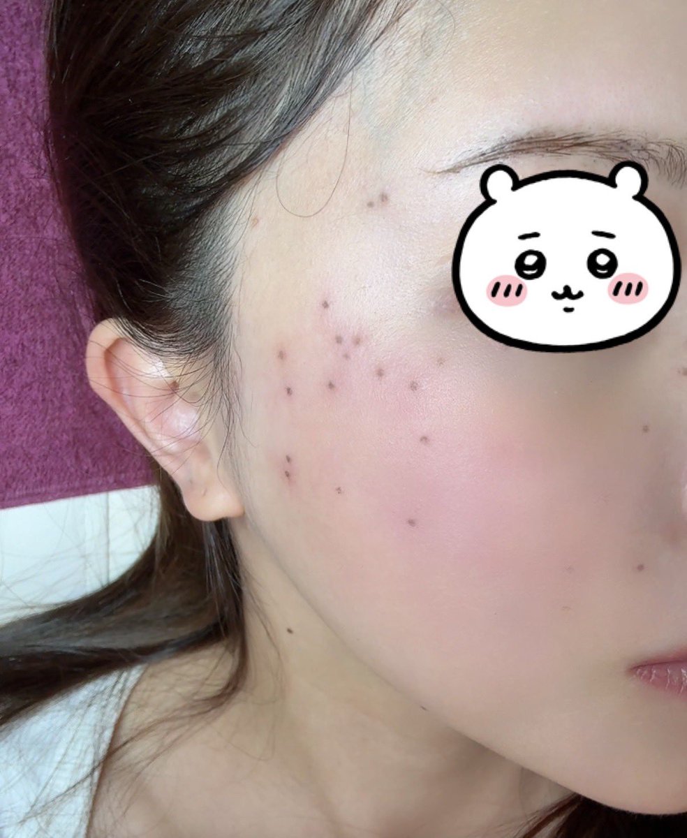 seeeraaamoon's tweet photo. やばい。3年前にシミ取りサロンハマって
だいぶ綺麗になったからしばらく行ってなかったんだけど、昨年エジプト行ったしなーと思って久々にシミ取り行ったら
めちゃ浮き出てきた！普段トーニングしててもこれ！笑 また通う
レーザーじゃ反応しないレベルの薄いシミにはこれしかないかやはり https://t.co/tTNp6yoJk0