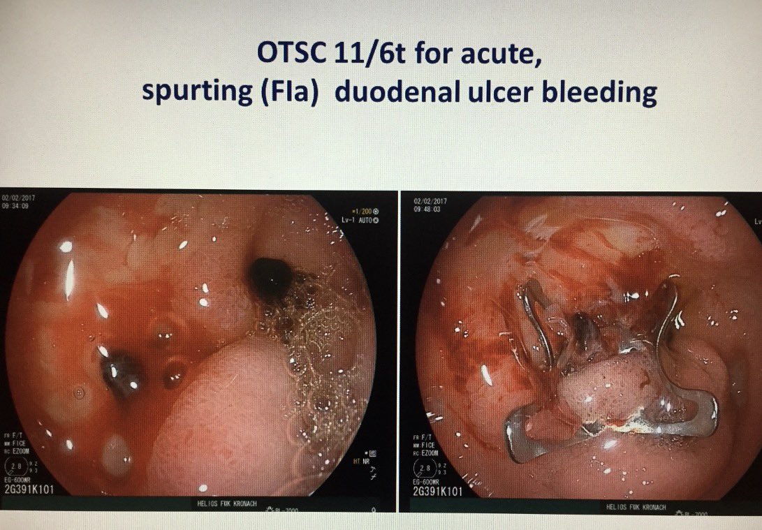 KMonkemuller's tweet photo. 🩸 The new paradigm is endoscopic monotherapy with over-the-scope clip 
 
New ESGE just out at ESGE days Milan 🇮🇹 
#ESGEguidelines
@EndoCollabcom @theendoscopist https://t.co/eb4buhg1h1